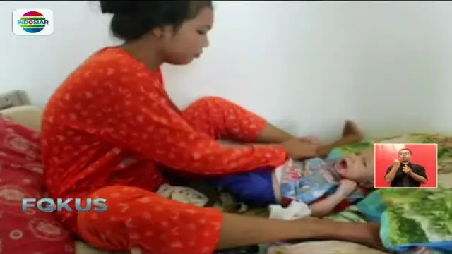 Kondisi Muhammad Adam Syahputra, bayi pendereita gizi buruk akibat diberi susu dewasa mulai membaik.