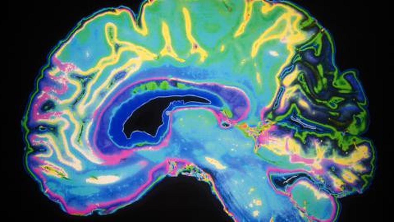 Stroke ringan bisa sebabkan Alzheimer