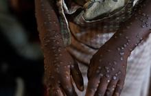 Dokter Sebut Mpox Bisa Picu Penyakit Komplikasi Serius