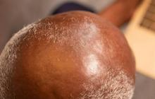 10 Bahan Alami untuk Menumbuhkan Rambut Botak, Bisa Dicoba