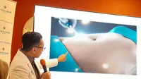 Liposuction Bantu Kurangi Lemak tapi Bukan Gantikan Gaya Hidup Sehat