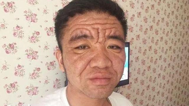 Penyakit Langka Buat Pria Ini Terlihat Lebih Tua 50 Tahun