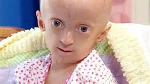Progeria, si Kecil dengan Muka Tua Karena Kelainan Genetis