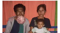 Yeskial Hun (30) warga Desa Huetalan Kecamatan Tobu Kabupaten Timor Tengah Selatan (TTS), menderita penyakit sejenis tumor dimulutnya.