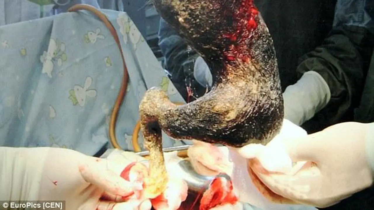 Gumpalan Rambut 4 Kg Bersarang di Perut Gadis 