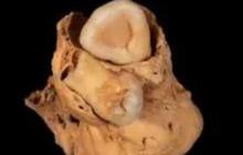 Arkeolog Temukan Kerangka Wanita Mesir Kuno Penderita Tumor Langka Bawa Jimat Penyembuh