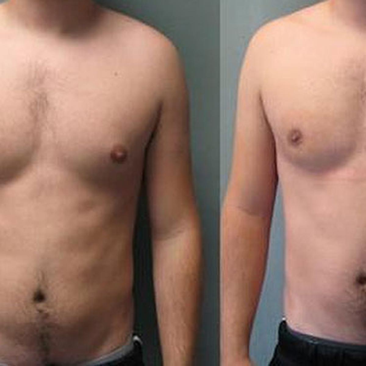 увеличенный сосок груди у мужчин фото 26