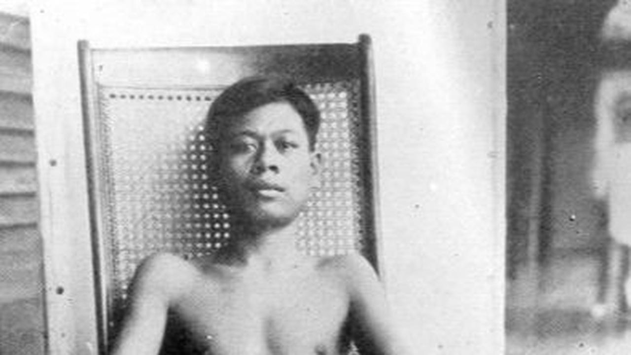 Penyebab Penyakit Beri-beri yang Perlu Diwaspadai, Begini Cara Mengatasinya