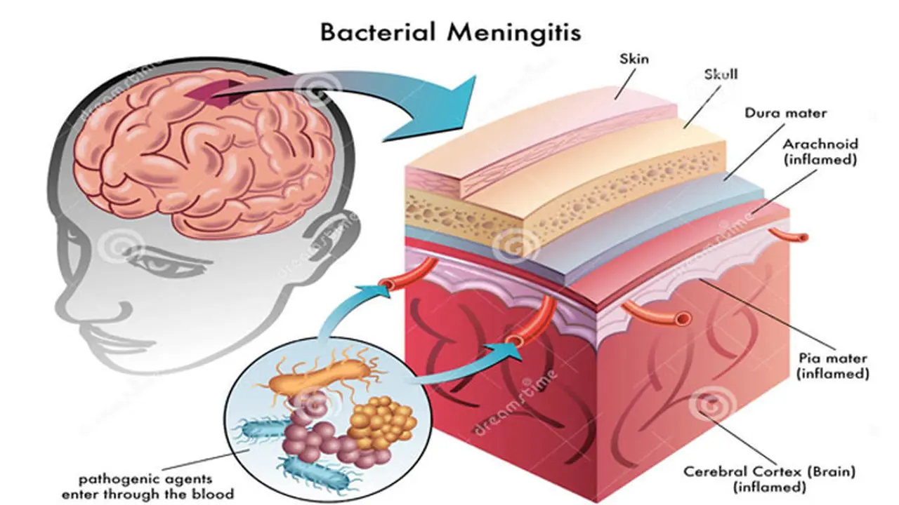 Orang Indonesia Wajib Vaksin Meningitis Sebelum ke Luar Negeri