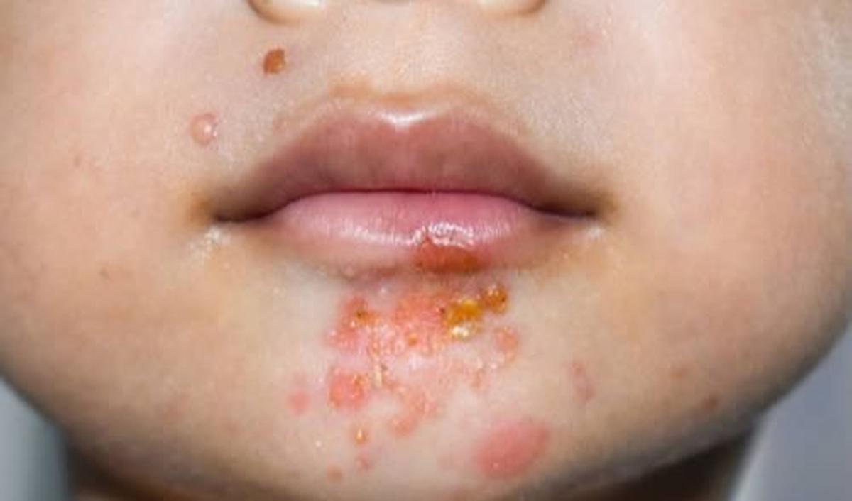 <b>3. Impetigo </b>