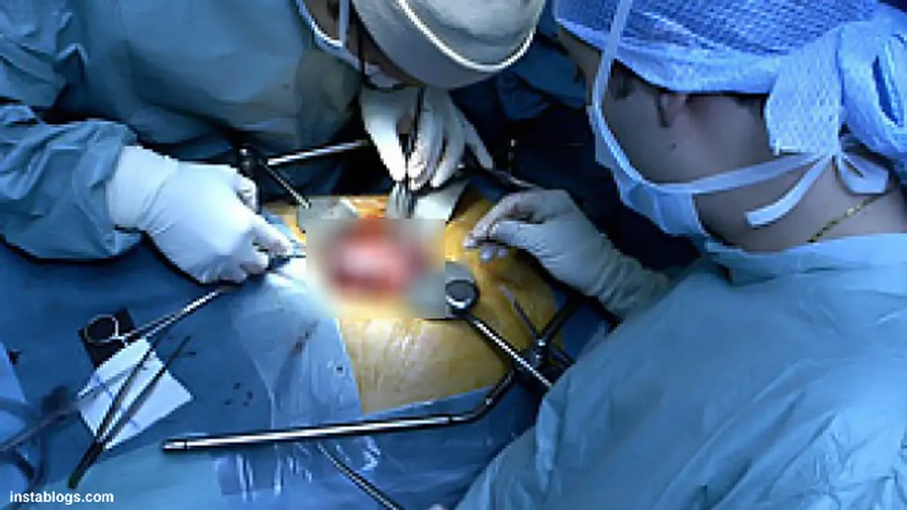 tranplantasi-organ-130830-b.jpg