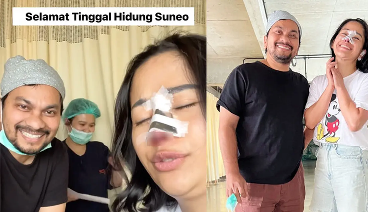 Tak mau disebut hidung Suneo, Farida Nurhan memutuskan operasi plastik di hidungnya. Perempuan kelahiran Lumajang 41 tahun silam itu mempercayakan ke dr Tompi. [Instagram/farida.nurhan]