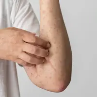 Tips Merawat Anak yang Terkena Campak agar Cepat Sembuh