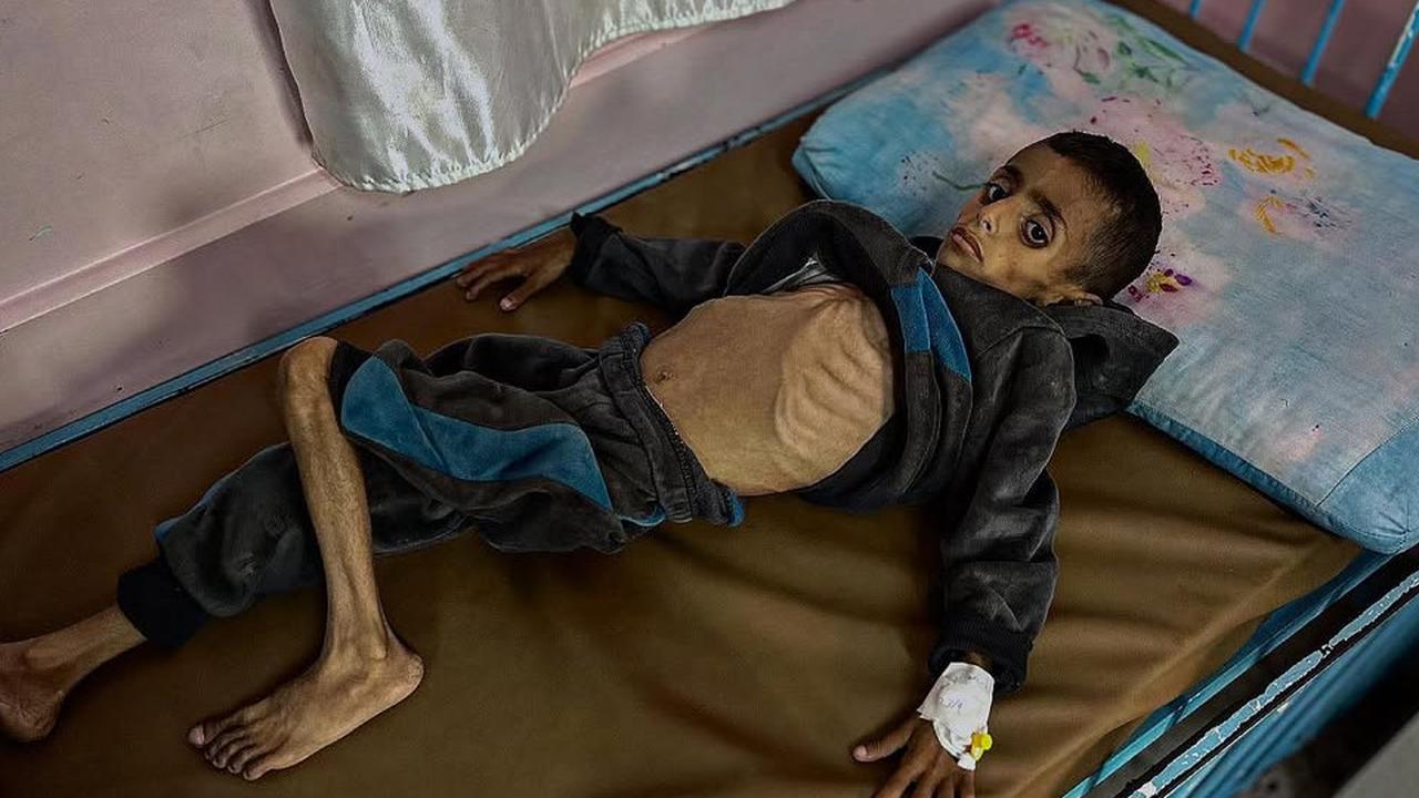 Tak Ada Air Bersih dan Susu, Anak-Anak Gaza Kena Wabah Meningitis