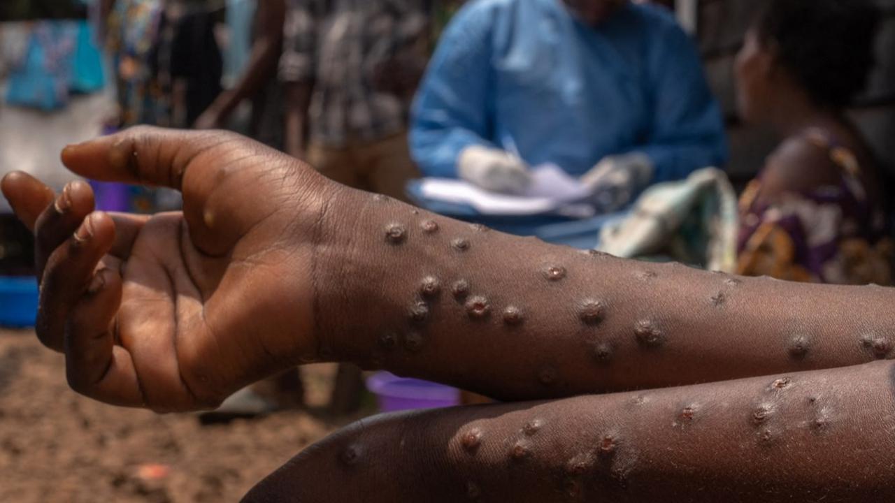 Wabah Mpox atau Cacar Monyet di Burundi