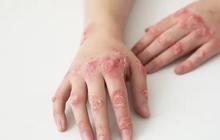 Kenali Gejala dari Impetigo, Pahami Pengobatan serta Cara Pencegahannya