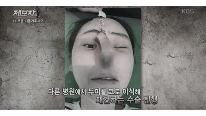 [Bintang] Dulu Cantik, Setelah Operasi Plastik Wajah 5 Wanita Ini Jadi…