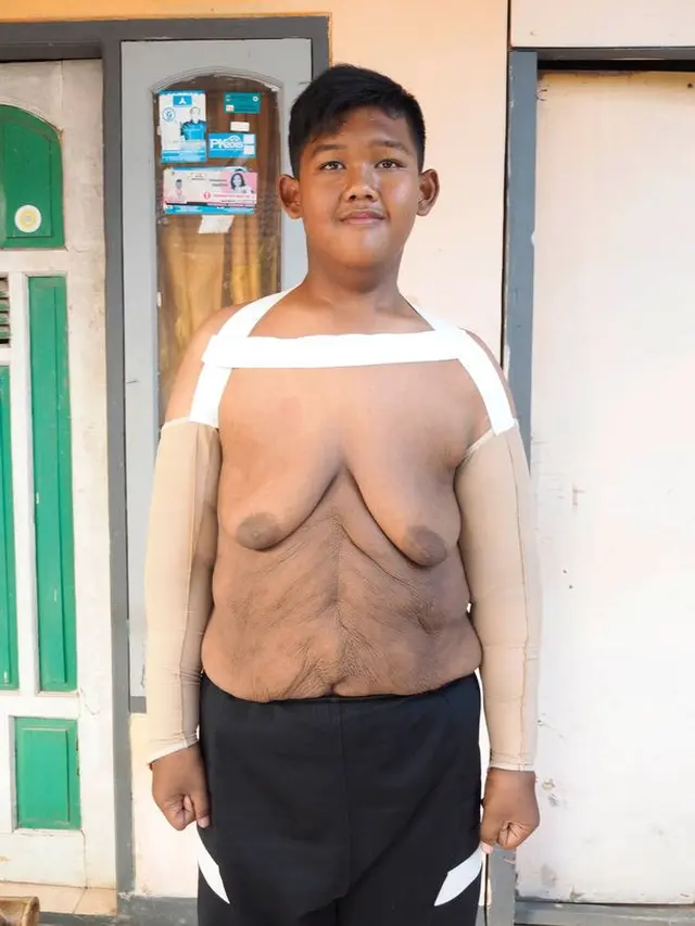 6 Potret Transformasi Arya Permana Bocah Berbobot Nyaris 200 Kg, Bikin Takjub