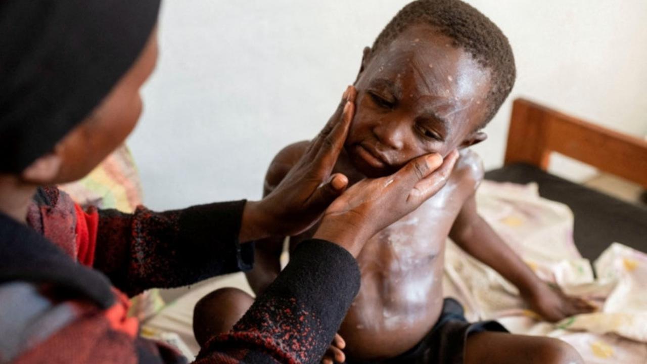 Penyakit Misterius di Kongo, Hampir 400 Korban dengan 79 Kematian Mayoritas Anak-Anak