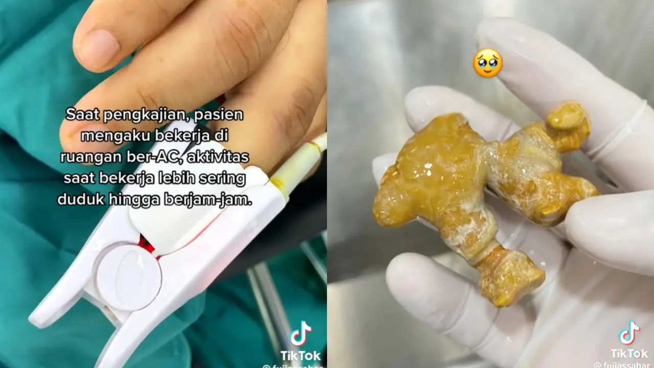 Viral Tenaga Kesehatan Temukan Batu Ginjal yang Berbentuk Seperti Jahe