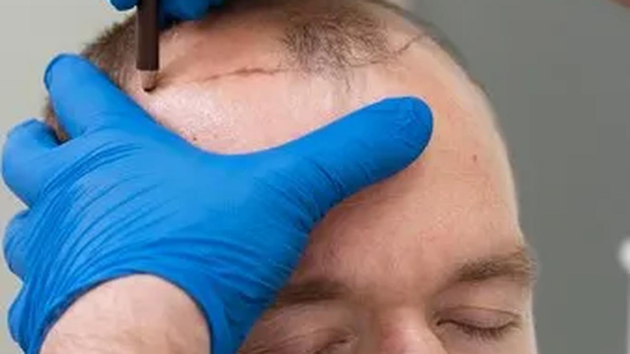 Stres Berat: Pengaruh Emosional pada Kesehatan Rambut