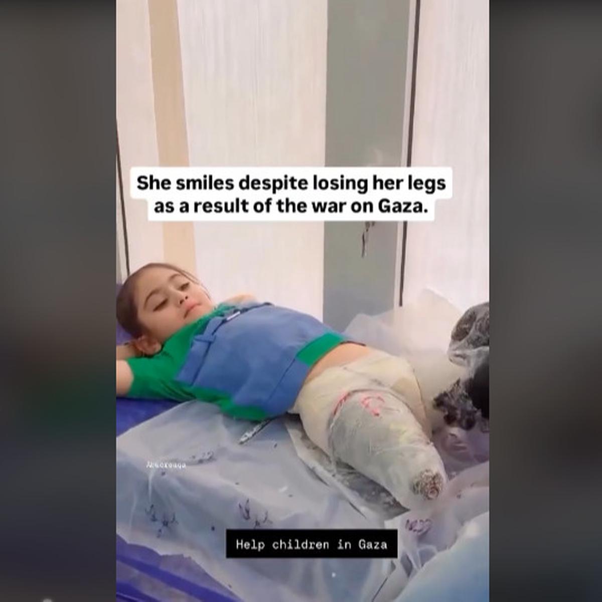 Sosok Luar Biasa Bocah Perempuan Palestina Masih Bisa Tersenyum Walau Kedua Kakinya Hilang Akibat Bom Israel