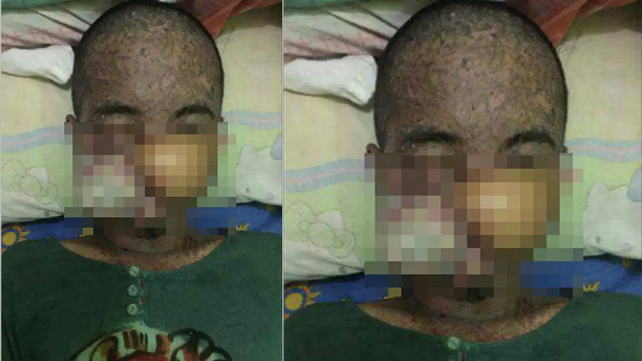 Idap Kanker, Eko Setiawan Perlu Hidung Palsu