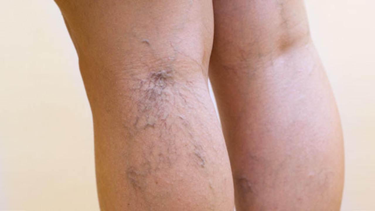 Cara Mencegah Munculnya Varises