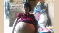 Bupati Bima Siap Bantu Pengobatan Warganya yang Derita Tumor 