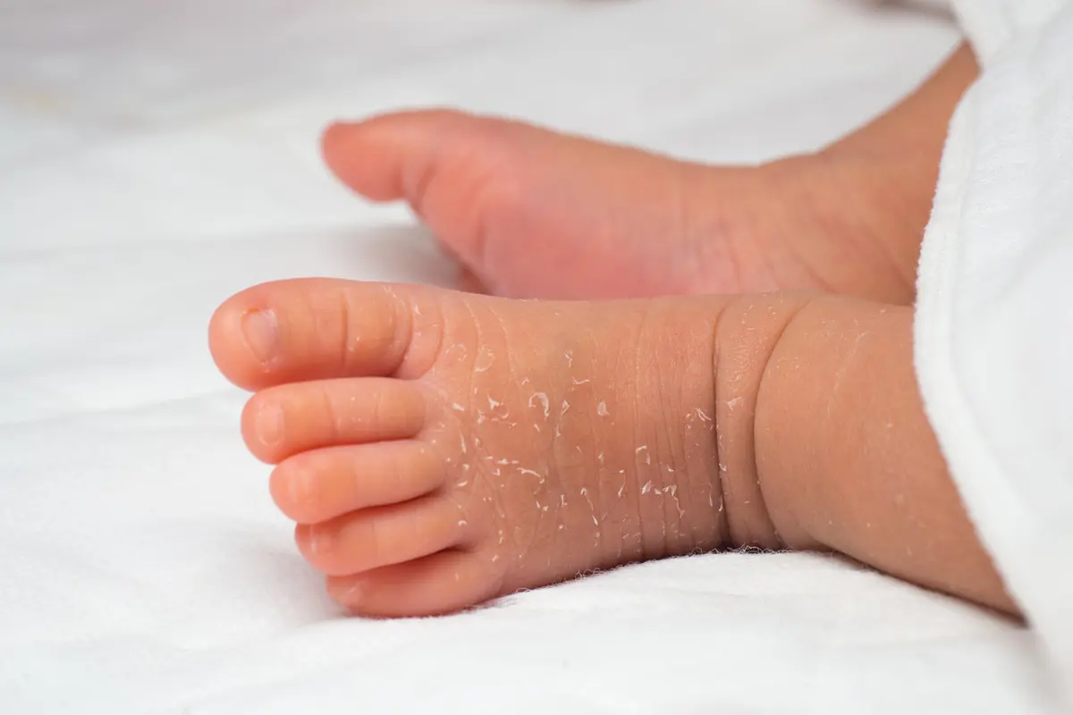 Kulit bayi - vernix (iStock)