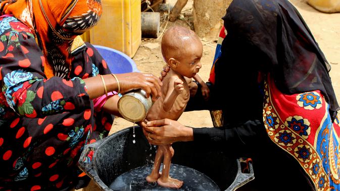 Seorang bayi yang menderita gizi buruk dimandikan dalam ember di Aslam, Hajah, Yaman, 25 Agustus 2018. Menurut LSM Save the Children, konflik Yaman berisiko membunuh seluruh generasi. (AP Photo/Hammadi Issa)
