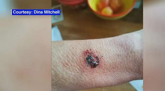 Pergelangan tangan wanita ini terbakar karena Fitbit miliknya meledak. (Doc: Dina Mitchell)