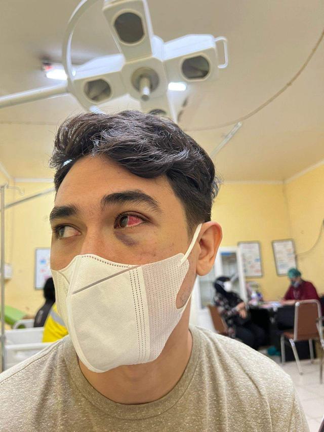 Rico Valentino usai menjalani visum kasus pemukulan