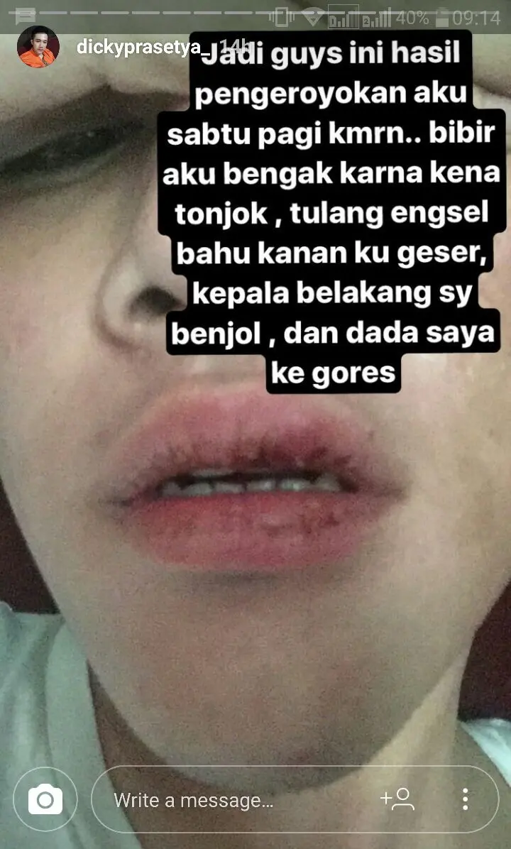 Dicky SMASH mengalami tindakan pengeroyokkan. (Instagram/dickyprasetya_)