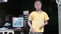 osok Ari Wibowo, remaja 16 tahun asal Tangerang sedang jadi sorotan dunia. Dia menderita kelainan kulit sejak lahir, bersisik mirip kulit ular. (Foto : Benedikta Desideria)