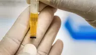 7 Warna Urine dan Artinya yang Perlu Anda Tahu