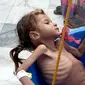 Seorang gadis yang menderita gizi buruk ditimbang di Pusat Kesehatan Aslam di Hajjah, Yaman, 25 Agustus 2018. Kelaparan diperparah dengan meningkatnya harga kebutuhan pokok dan turunnya nilai mata uang Yaman akibat konflik. (AP Photo/Hammadi Issa)