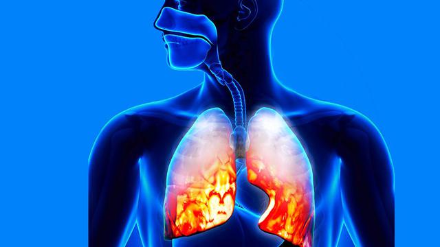 [Bintang] Apa Itu Pneumonia, Penyakit yang Menyerang Hillary Clinton