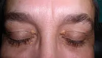 Bukan cuma faktor genetik, xanthelasma juga bisa muncul karena kadar kolesterol yang tinggi.
