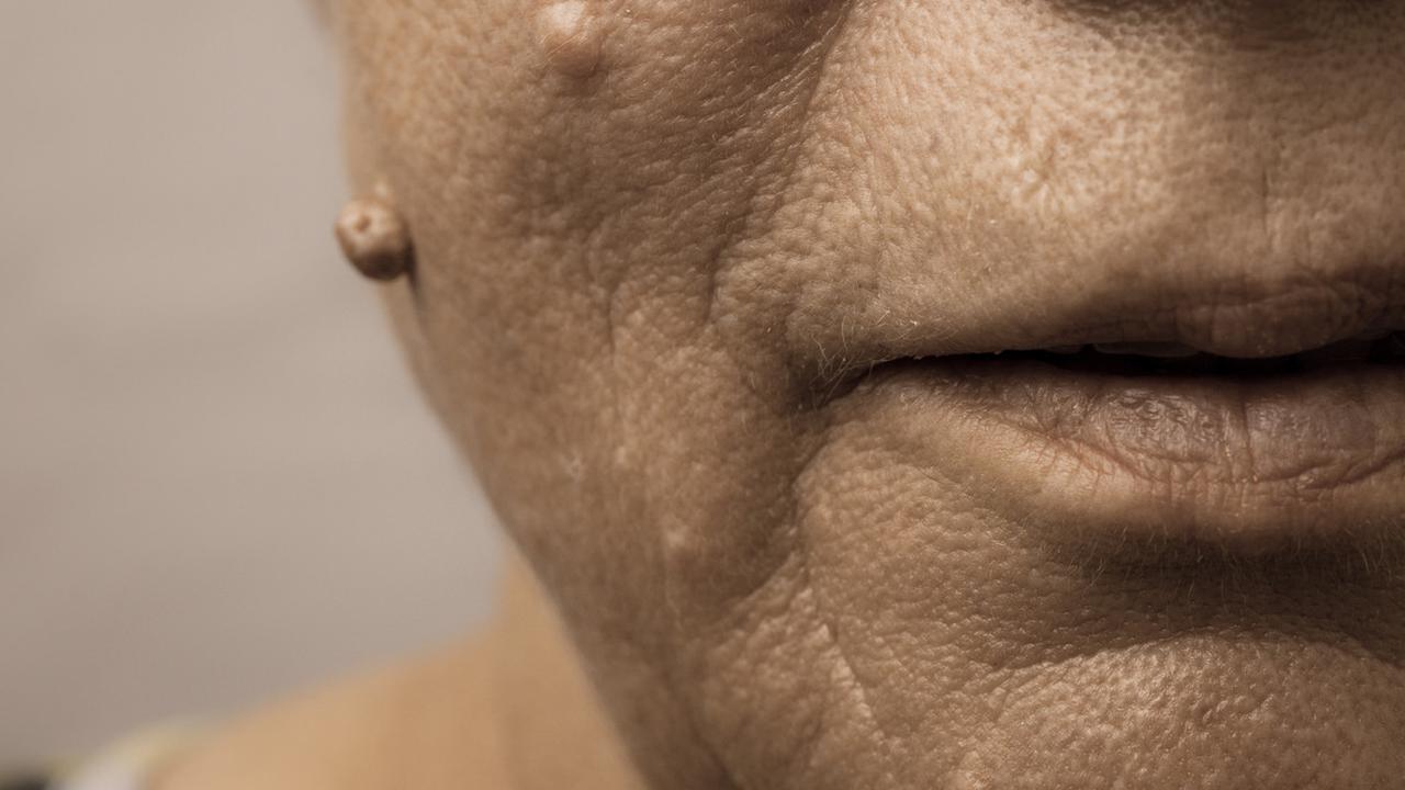 Cara Menghilangkan Kutil di Wajah