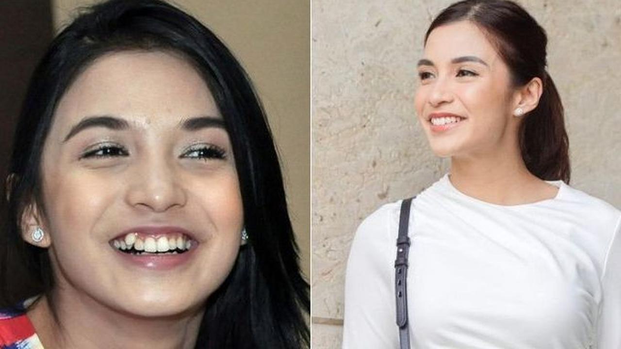 Chelsea Olivia, sebagai ibu dari dua anak, memutuskan untuk merapikan giginya dan menghilangkan ciri khasnya yang selama ini adalah gigi gingsul.