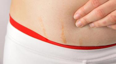 028436700_1483454246-Perhatikan-Ini-Jika-Ingin-Hilangkan-Stretch-Mark