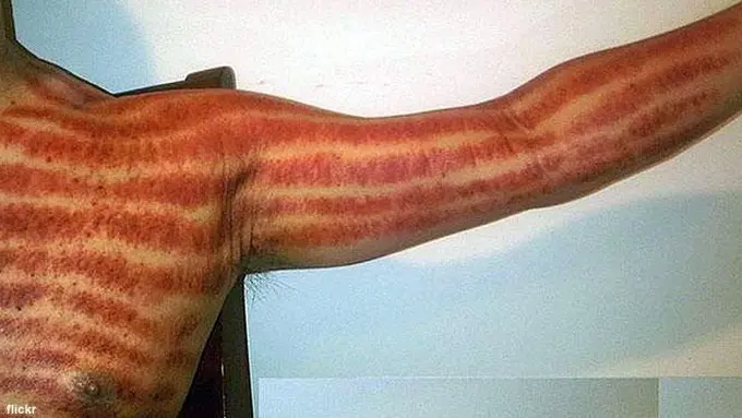 Selain Kerokan, Ini Obat Tradisional untuk Atasi Masuk Angin