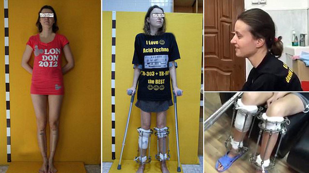 Wanita Ini Lakukan Operasi kaki demi Jadi Model