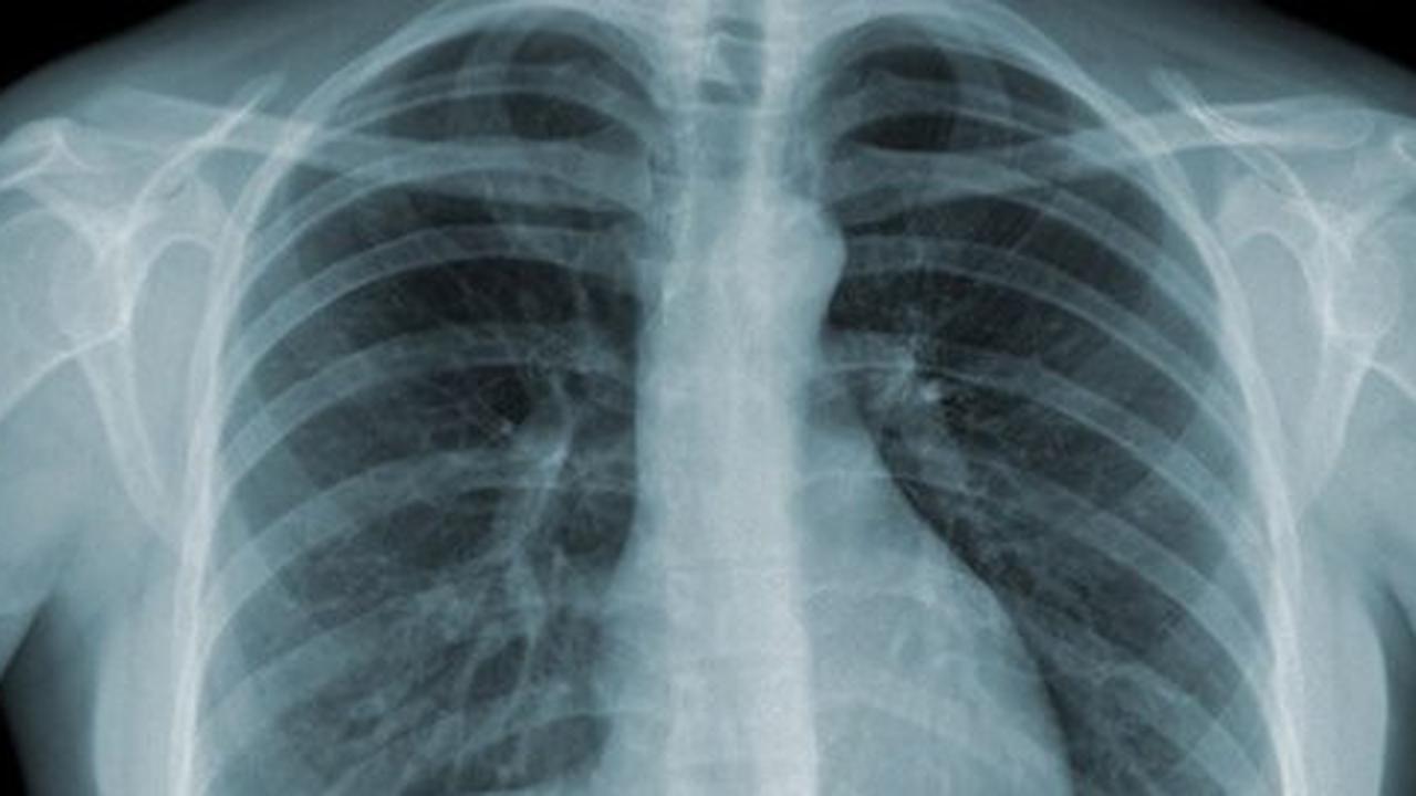 Yuk ketahui fakta-fakta penting tentang Tuberculosis!