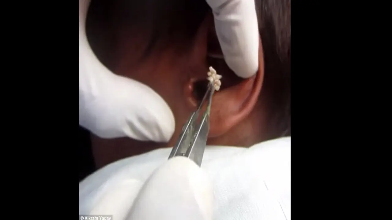 Larva telur lalat. (Daily Mail/Dr Yadav)