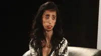 Derita Penyakit Langka, Lizzie Jadi Wanita Terjelek di Dunia
