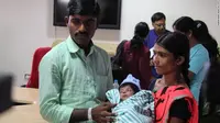 Bayi yang terlahir dengan 4 kaki dan dua penis berhasil dioperasi ( Narayana Health City)