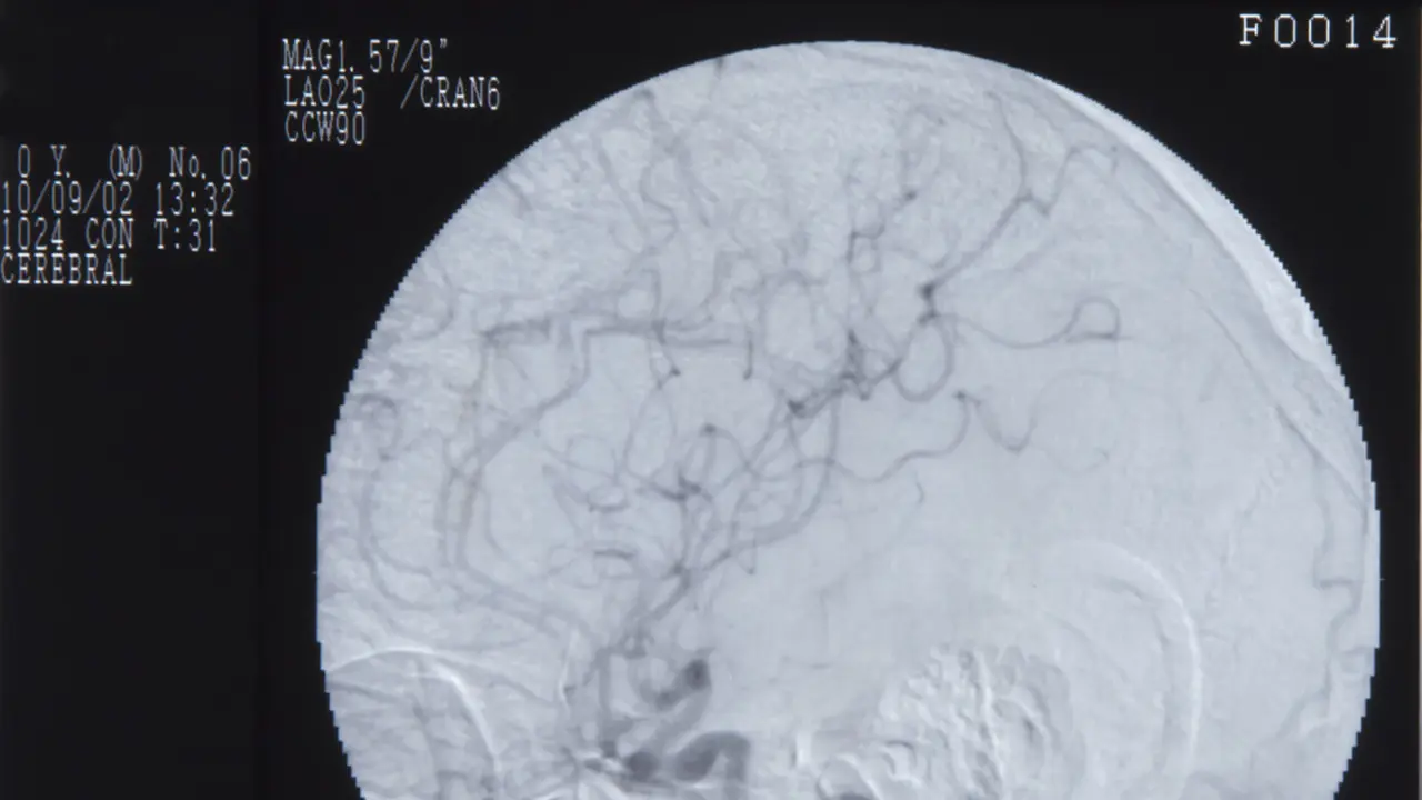 Prosedur Brain Washing (Cerebral Angiography)