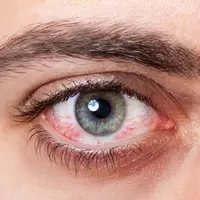 Ilustrasi Mata Merah Credit: freepik.com